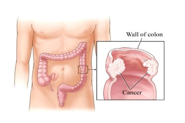 Colorectal Oncology