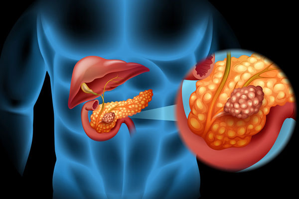 Pancreas Oncology