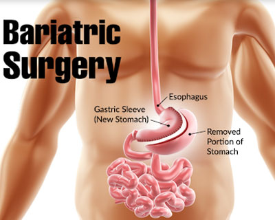 Fat Removal (Bariatric