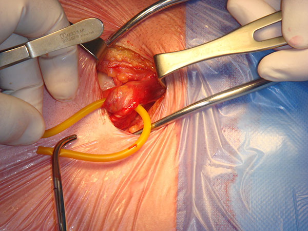 Hernia Surgery