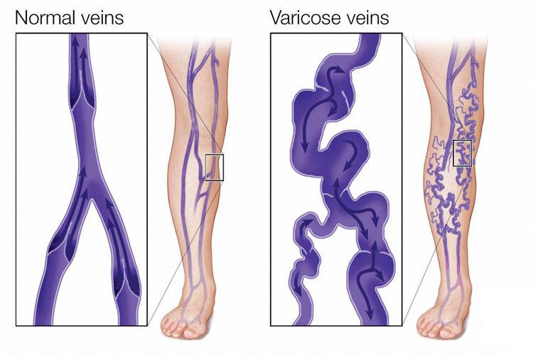 Vericose Vein Treatment,Rainbow Hospital,Kolhapur